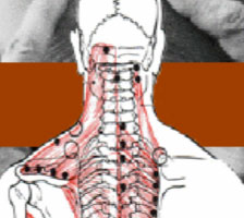 Dry Needling