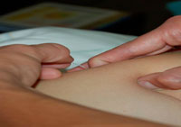 Dry Needling